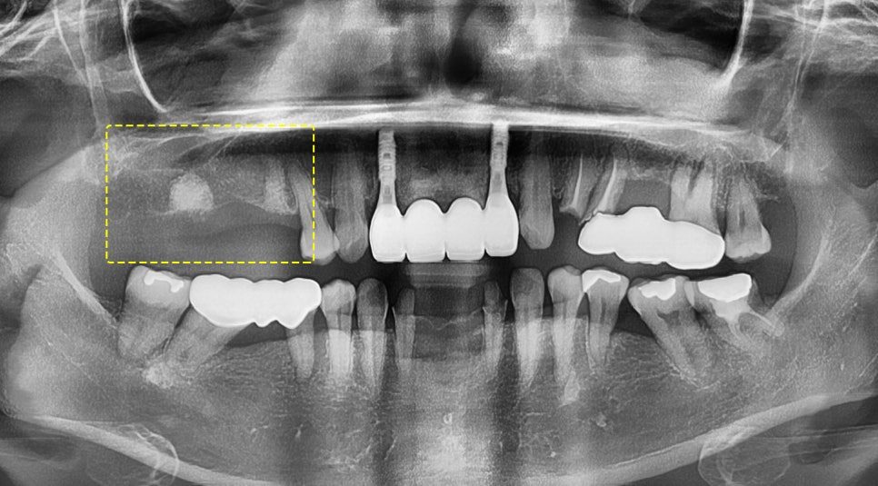 Panoramic dental X-ray showing the finished implant restorations