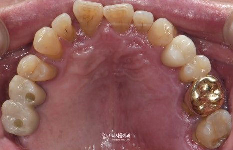 Intraoral photograph of the upper teeth from below with a gold crown at the back and a gap beside it