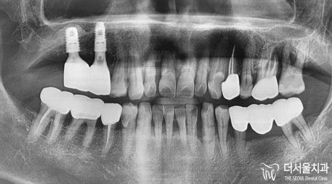 Implants When You Have Diabetes: Clearance First, Then a Minimal Incision