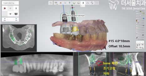 CT cross-section with the planned implant and its dimensions marked in English