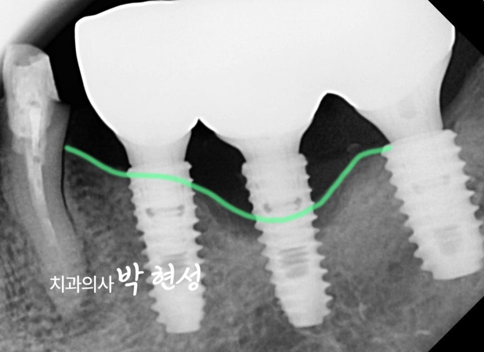 Close-up dental X-ray of the replacement implants with the bone level traced in green