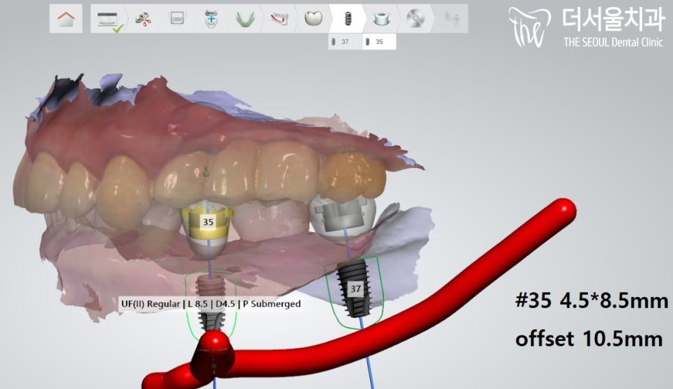 Planning software showing the scanned arch beside a cross-section with the implant dimensions marked in English