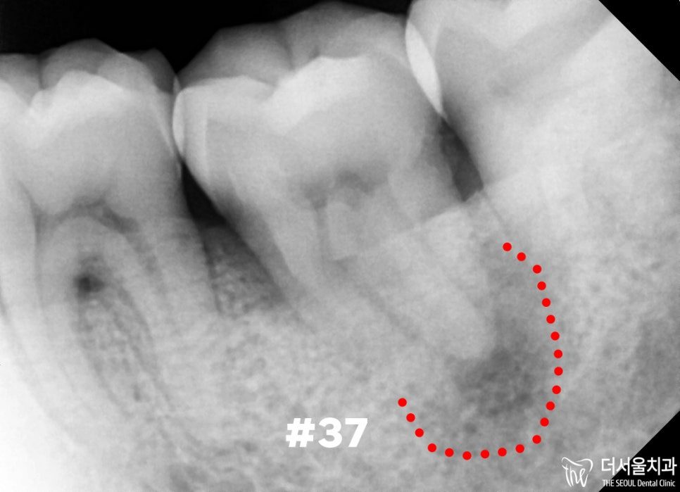 Close-up dental X-ray with a lower molar outlined in red and marked with its tooth number