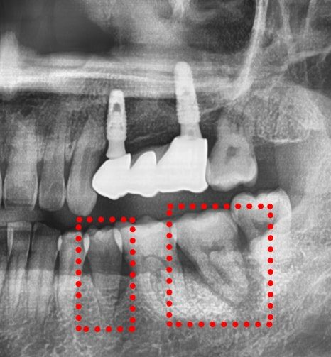 Three Implants in One Mouth, Three Different Levels of Difficulty