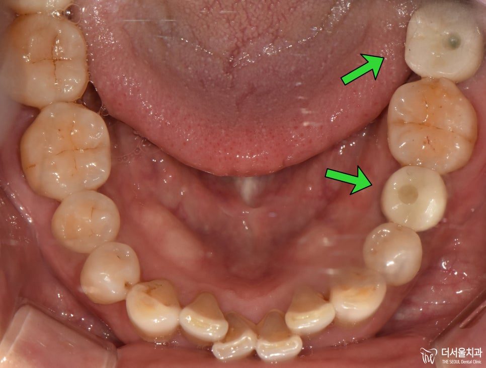 Intraoral photograph of the lower teeth from above with arrows pointing at the teeth to be replaced