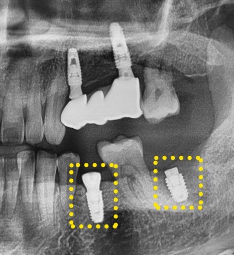 Cropped panoramic dental X-ray with the placed fixtures boxed in yellow