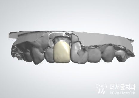 Three-dimensional digital model of the teeth with the new crown designed on the front tooth