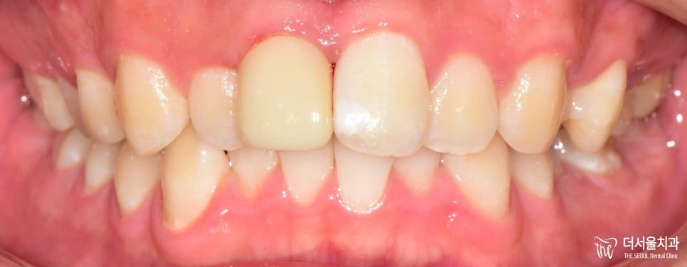 A Broken Front Tooth: Three Levels of Damage, Three Different Treatments