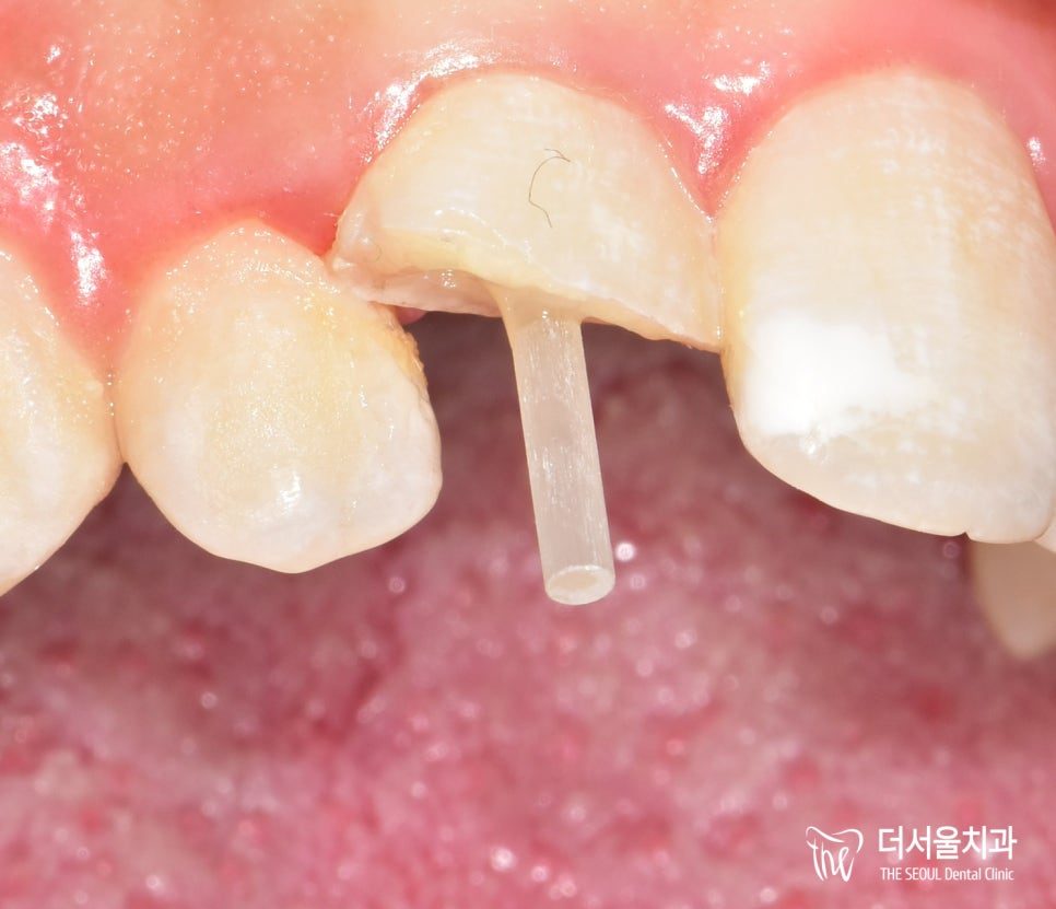 Close-up photograph of a post cemented into the root of a front tooth, standing above the gum