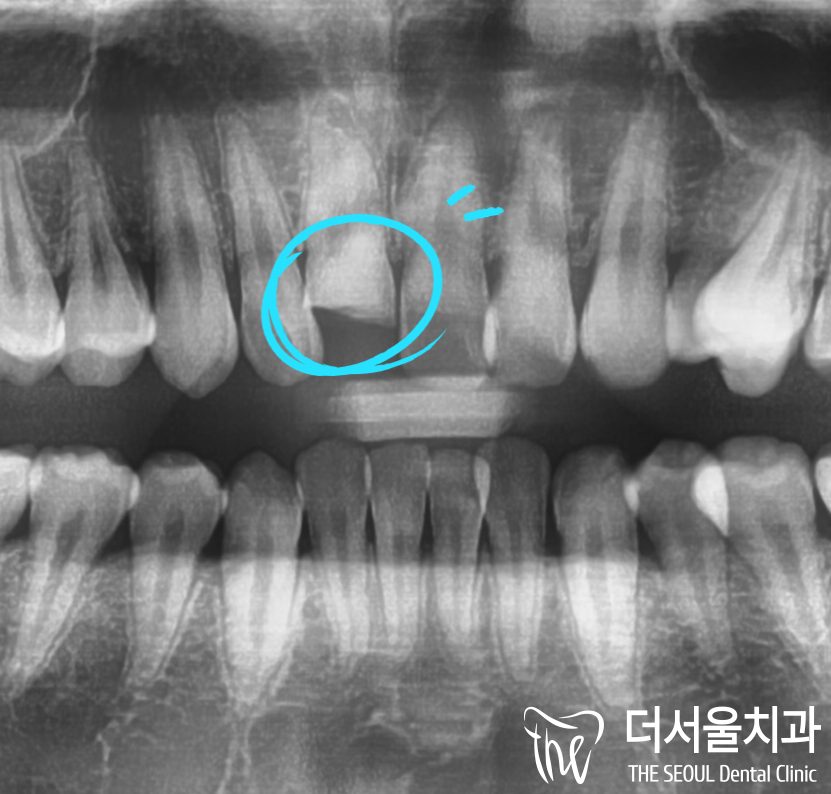 Close-up dental X-ray of the upper front teeth with the damaged tooth circled