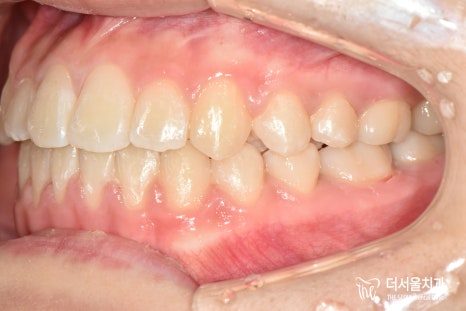Intraoral photograph of the teeth from the side before treatment