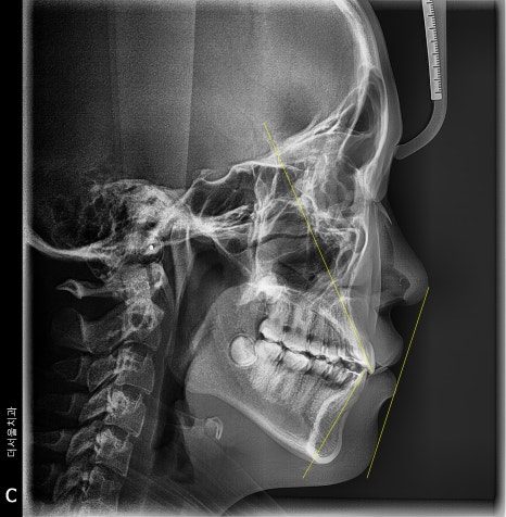 Correcting a Protruding Mouth Without Extractions