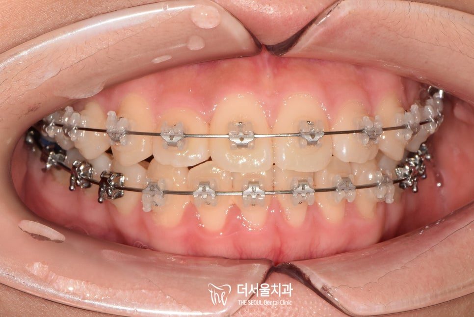 Intraoral photograph of the front teeth with fixed braces bonded on