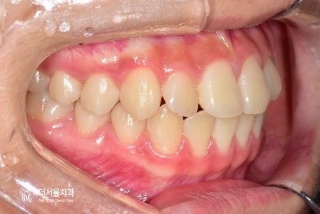 Intraoral photograph of the teeth from the side eighteen months into treatment