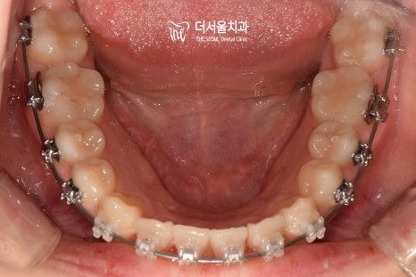 Intraoral photograph of the lower teeth from above with braces on the inside surfaces