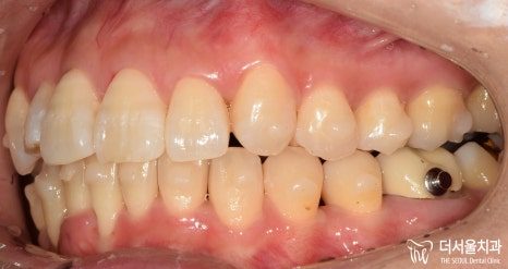Intraoral photograph of the teeth from the side at the start of treatment