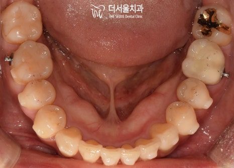 Severe Crowding, Clear Aligners, No Extractions – and Deliberately Slow