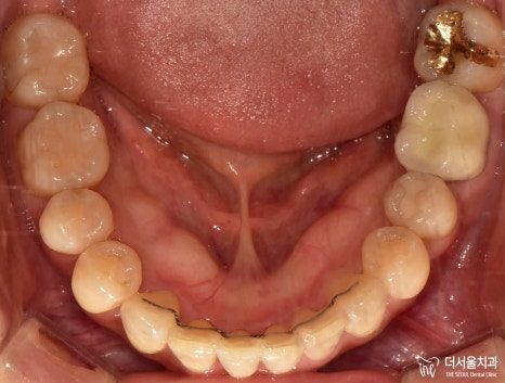 Intraoral photograph of the lower teeth from above partway through aligner treatment