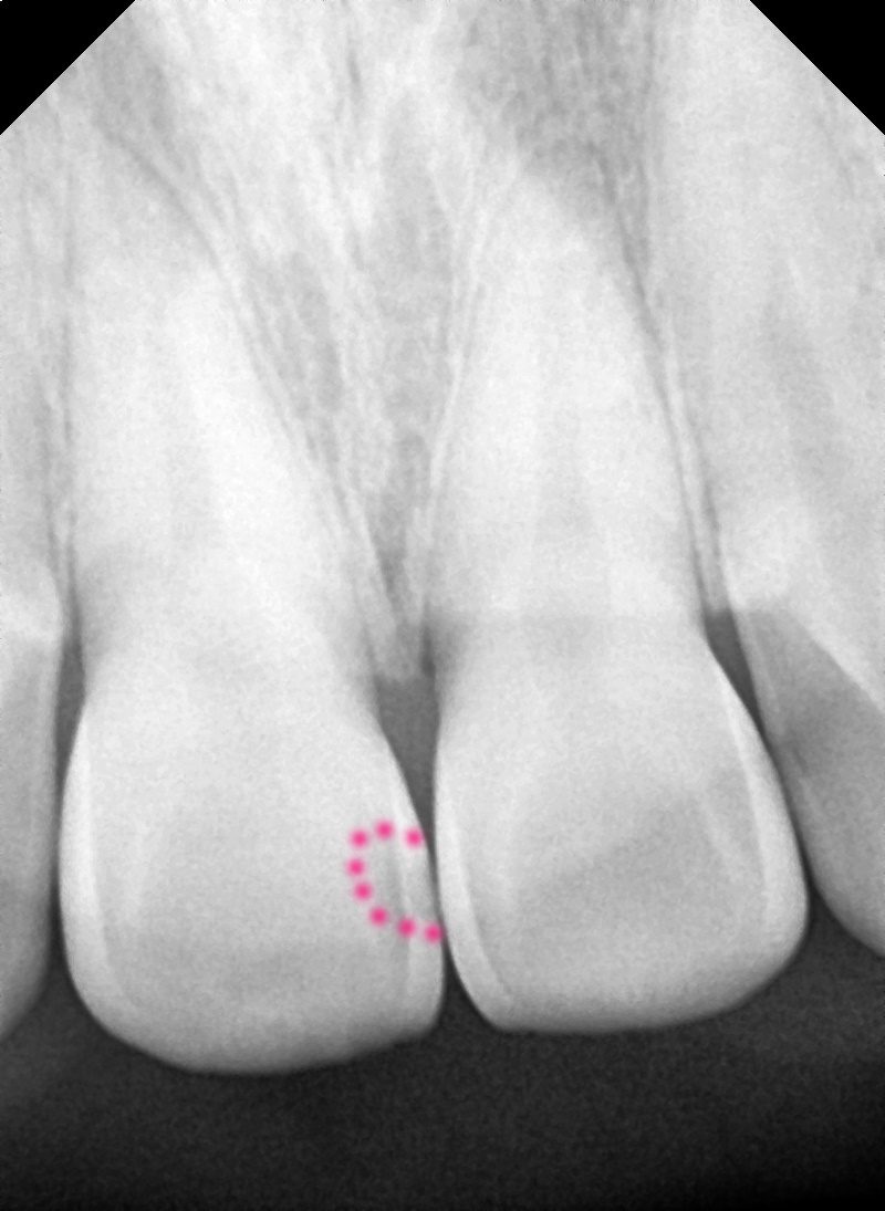 Close-up dental X-ray of the two upper front teeth with the area between them circled