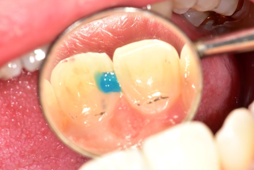 Close-up mirror view of the front tooth with a matrix band placed before the resin is built up