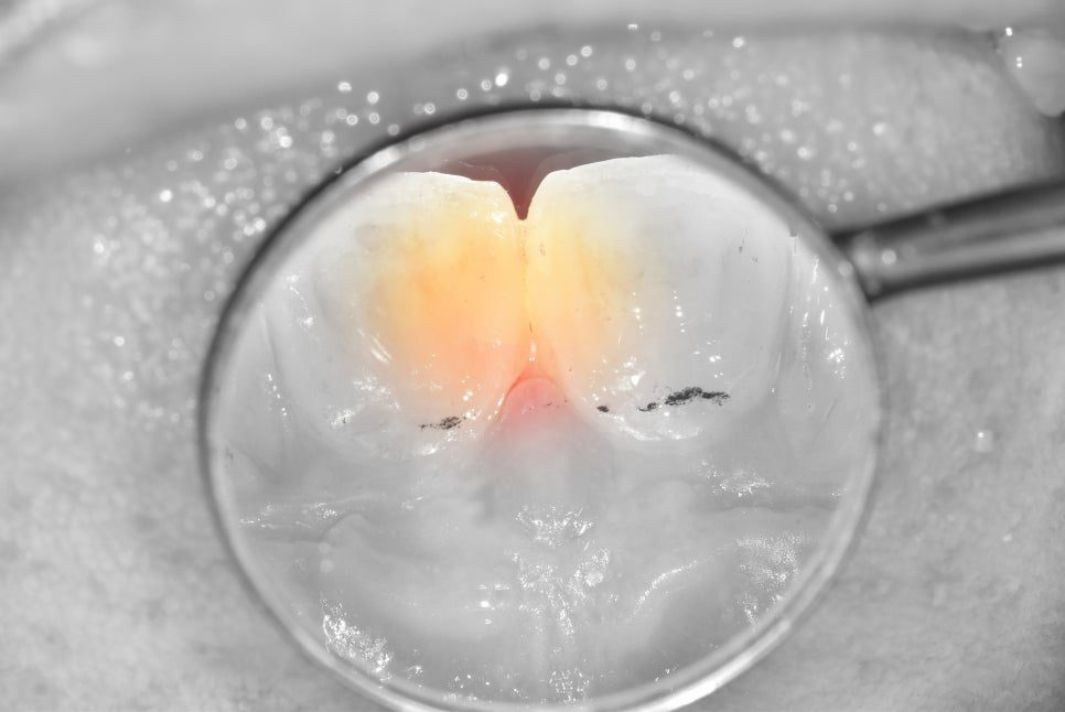 Close-up mirror view of the two front teeth with the finished resin filling in place