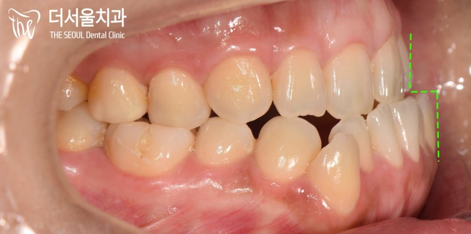 Intraoral photograph from the left side showing the same reversed bite relationship