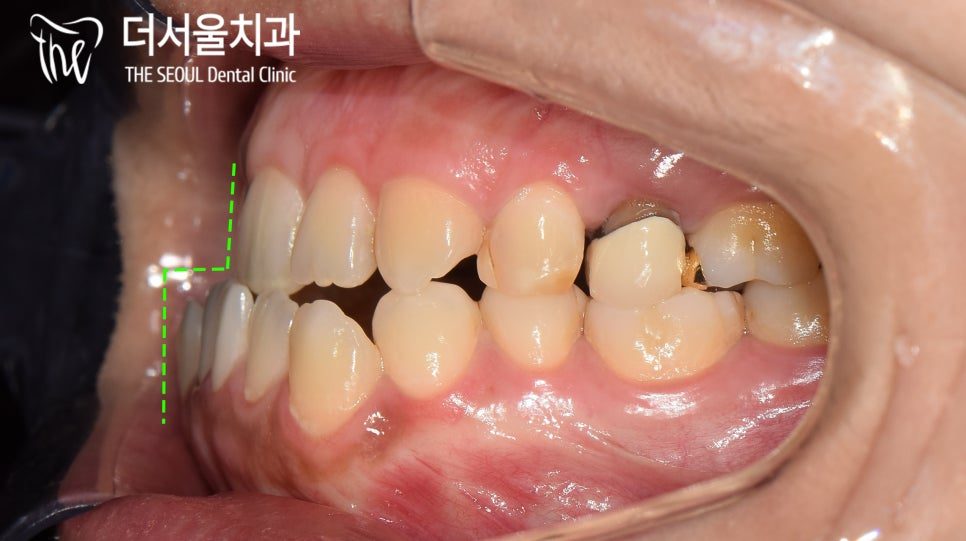 Intraoral photograph from the right side showing the lower teeth positioned forward of the upper