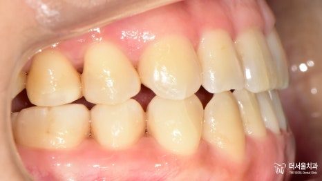Intraoral photograph from the side at the end of treatment showing the corrected bite relationship