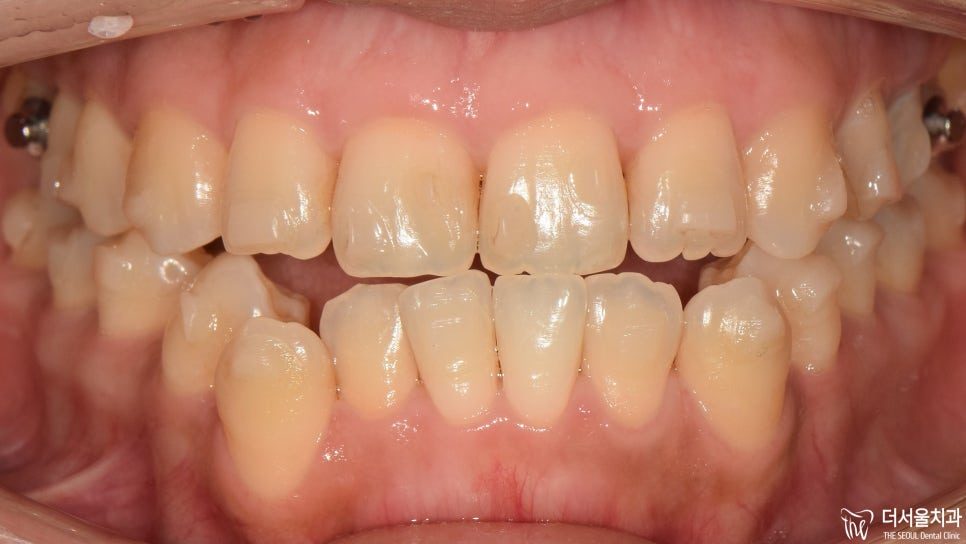 Can Clear Aligners Fix an Underbite Without Surgery?