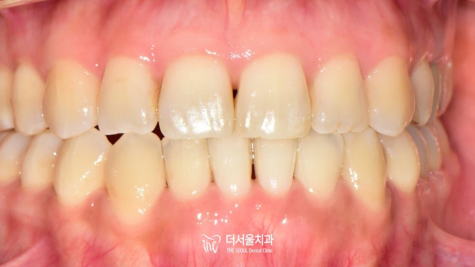 Intraoral photograph of the front teeth in bite, now with the upper teeth closing in front of the lower