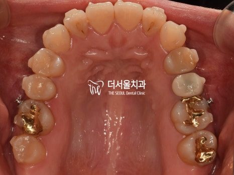 Occlusal photograph of the upper arch showing the full row of teeth including the back molars