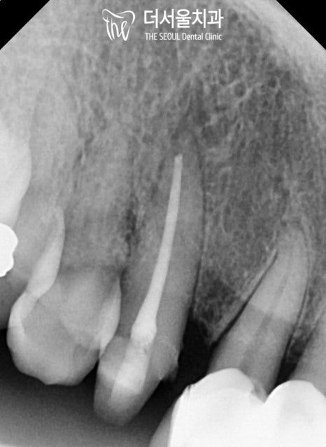 Periapical X-ray of the same canine after root filling, with a build-up added on top of the remaining tooth