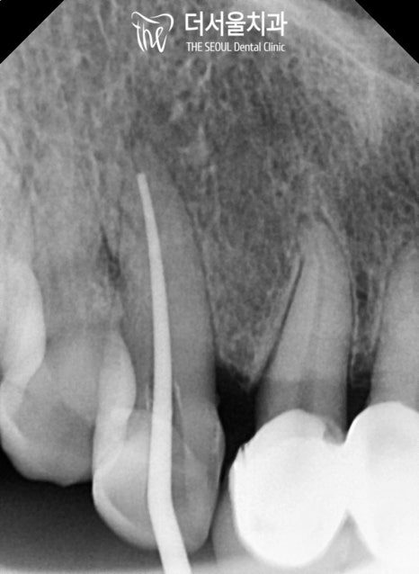 Periapical X-ray of an upper canine with root filling material running the full length of the root