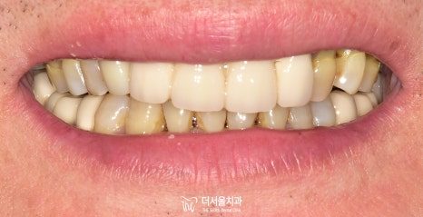Close-up of the teeth between the lips, the upper front teeth appearing long with darker bands at the gum line