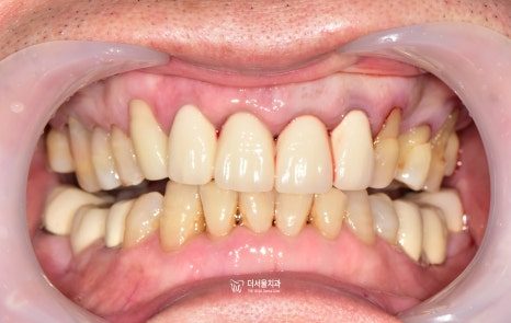 Notches Worn at the Gum Line: When Resin Is Enough and When It Is Not