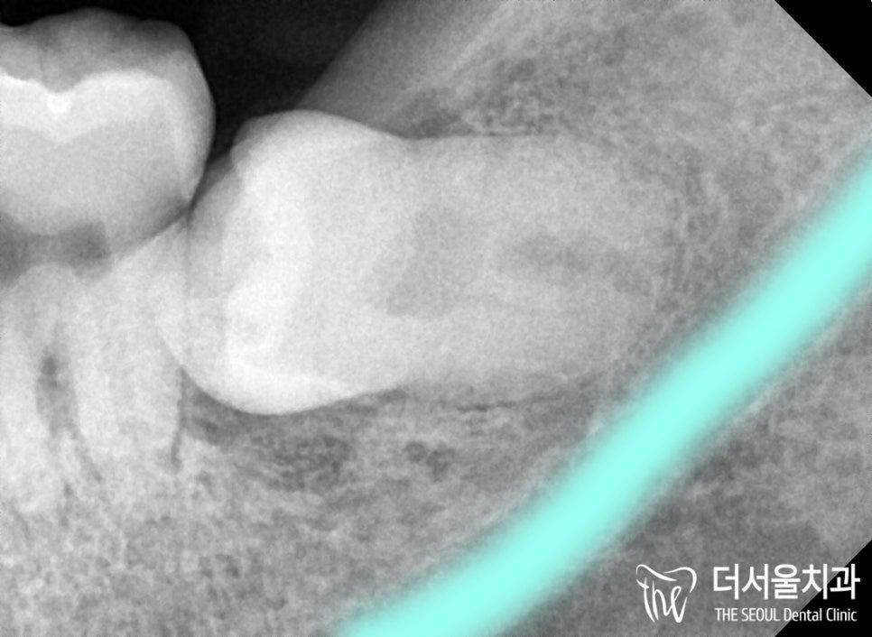 Close-up dental X-ray of a lower wisdom tooth lying on its side, its crown pointing into the second molar