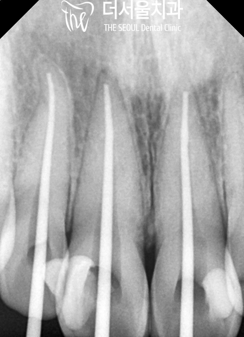Periapical X-ray of the upper front teeth showing posts and cores built into the root-filled teeth