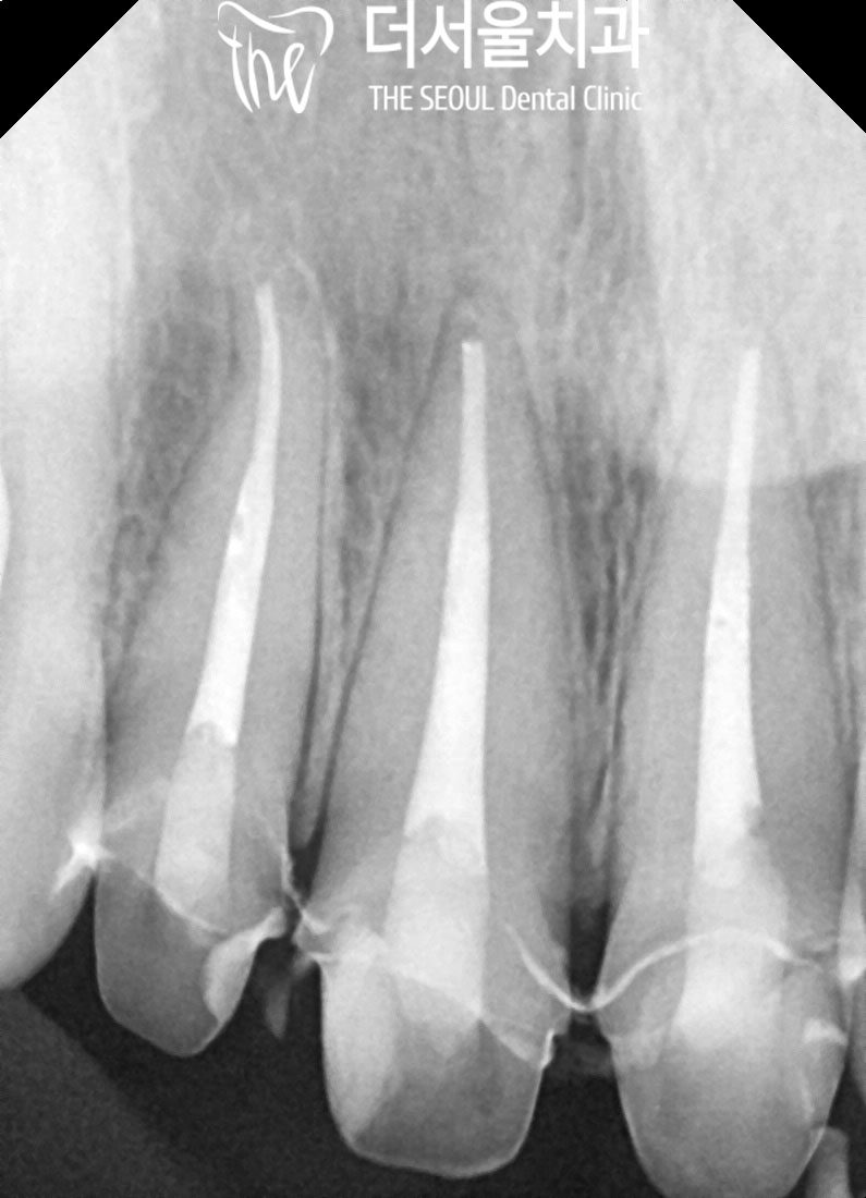 Periapical X-ray of the upper front teeth with root filling material in the canals