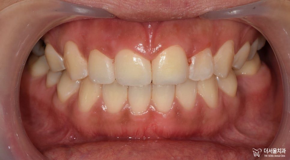 Retracted intraoral photograph of the upper and lower front teeth after the crown was fitted