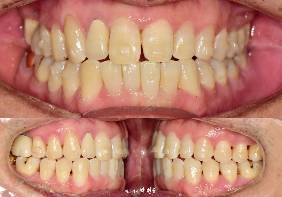 Three intraoral photographs of the teeth from the front and both sides during aligner treatment