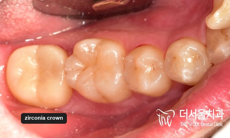 Intraoral photograph of a lower molar restored with a zirconia crown, alongside the neighbouring teeth