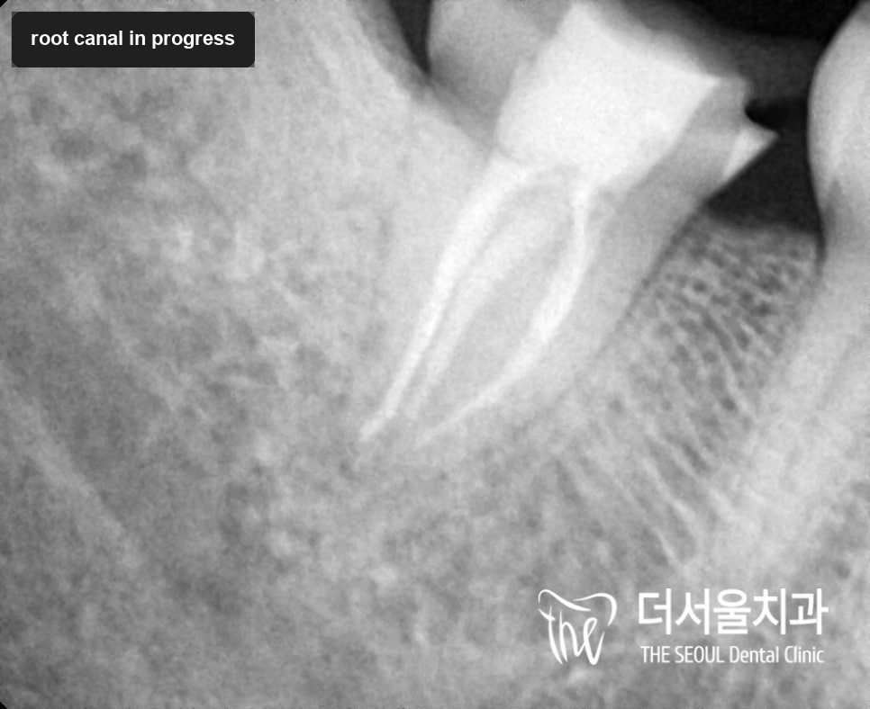 Close-up dental X-ray of a lower molar root, the canals showing as two pale lines running to their ends