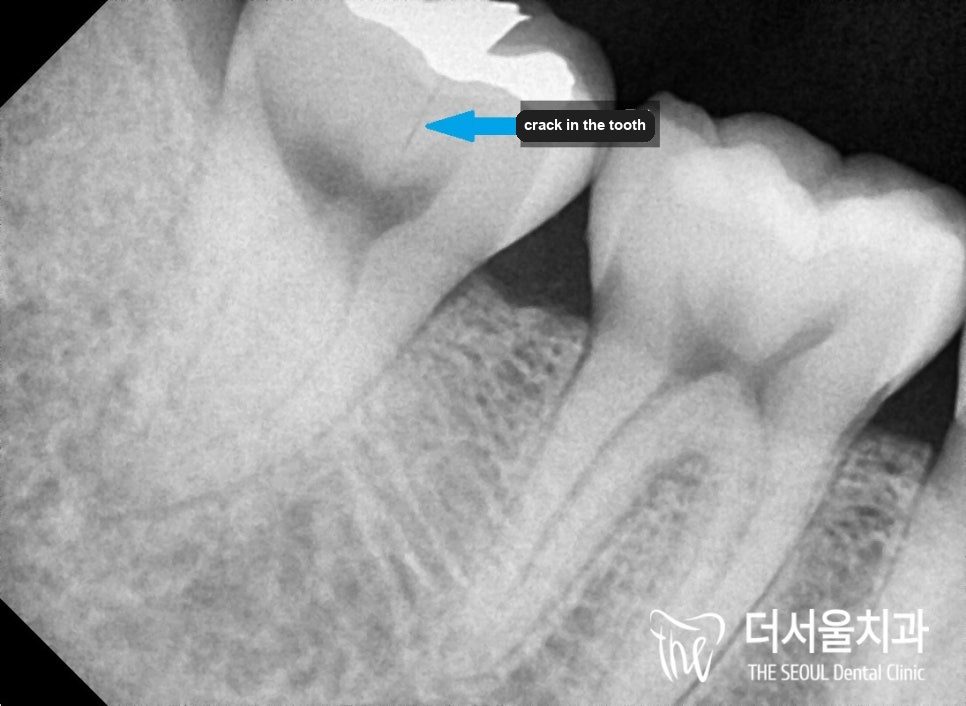 Close-up dental X-ray of two lower molars, the front one carrying a large bright restoration, with an arrow pointing at the tooth body beneath it