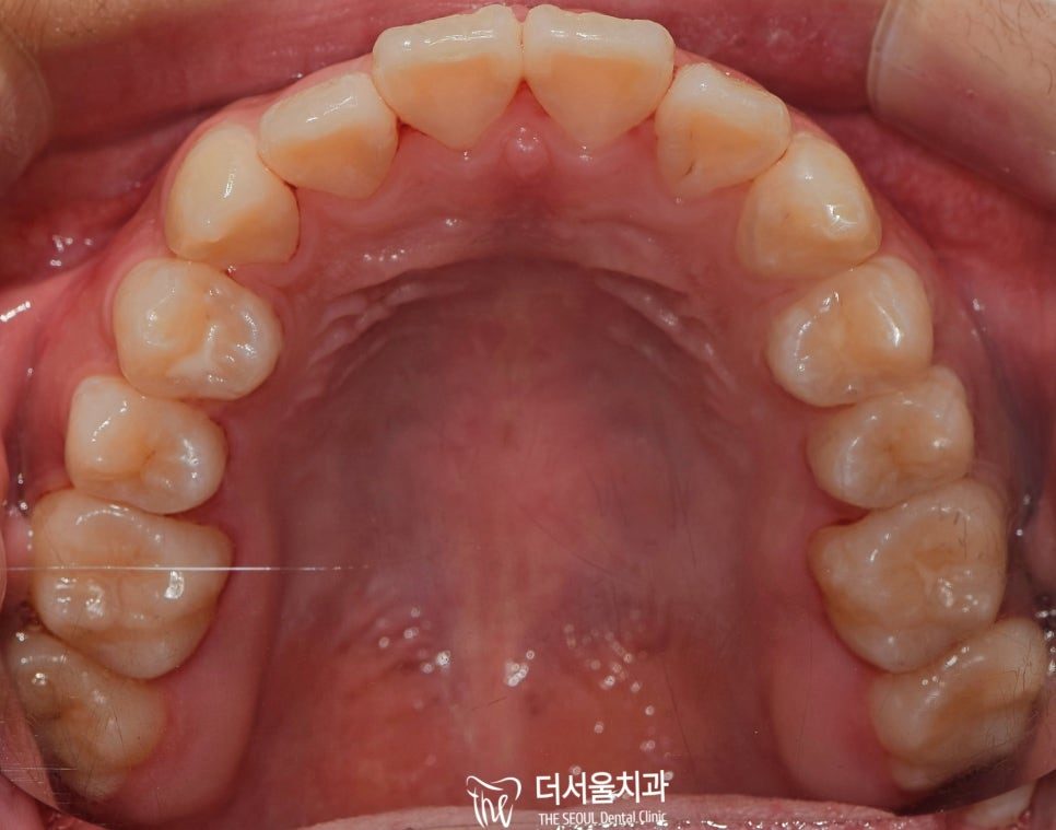 Occlusal intraoral photograph of the upper arch showing the alignment of the teeth from above