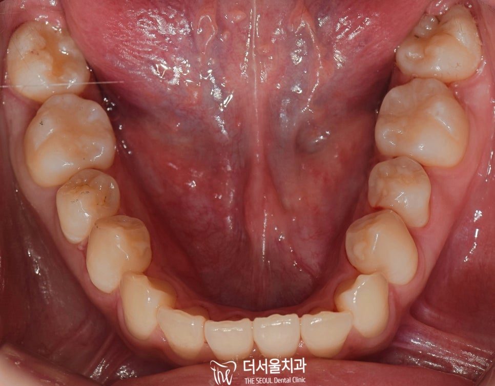 Occlusal intraoral photograph of the lower arch showing the alignment of the teeth from above