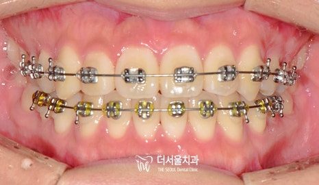 Frontal intraoral photograph of the upper and lower teeth with fixed brackets and archwires on both arches