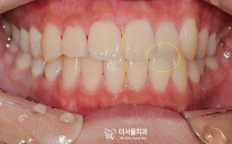 Clear Aligners or Fixed Braces: What Decides Which One Suits You