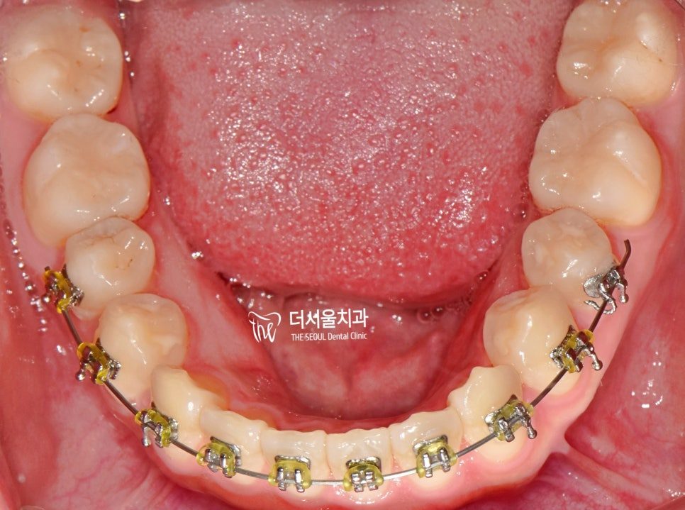Occlusal intraoral photograph of the lower arch with fixed brackets and an archwire in place