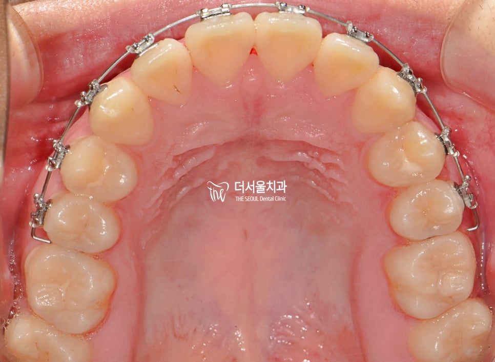Occlusal intraoral photograph of the upper arch with fixed brackets and an archwire in place