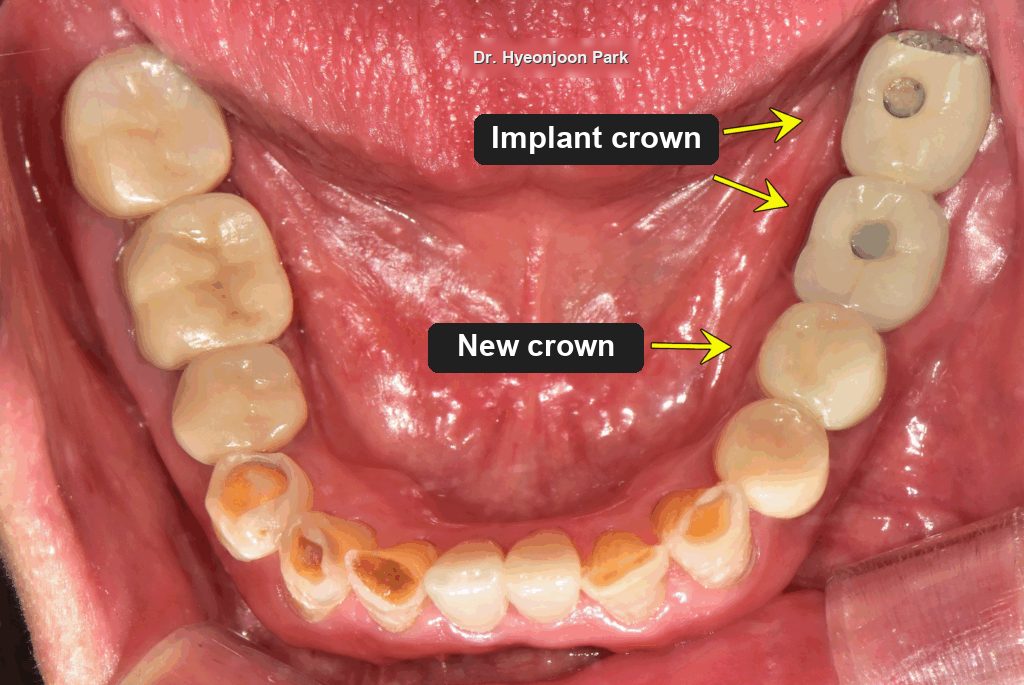 Intraoral photograph of the lower teeth with the new implant restoration in place at the back